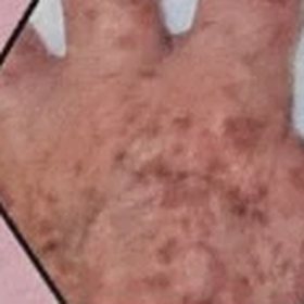 Age spots on the back of a hand