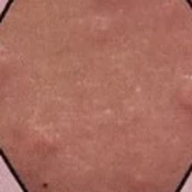 Blocked sebaceous glands
