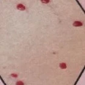 Small red blood spots on the skin