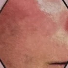 The same cheek after treatment, with the redness cleared