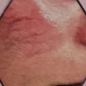 Cheek with visible red dilated capillaries before treatment