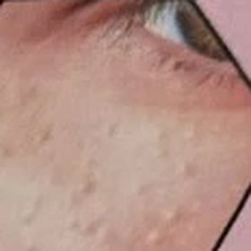 Milia spots beneath the eye