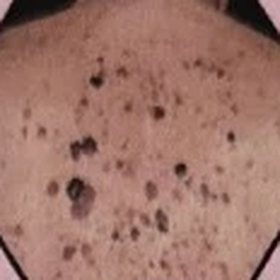 Seborrhoeic warts across the back