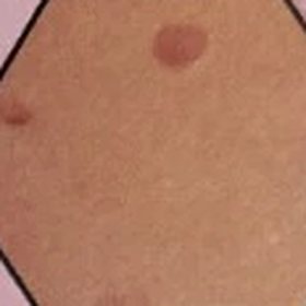 Skin tags