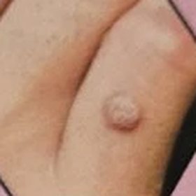 A wart on the skin